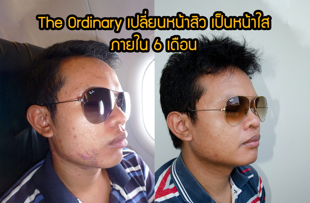 The Ordinary เปลี่ยนหน้าสิว เป็นหน้าใส