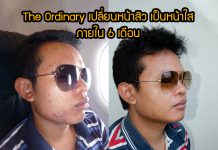 The Ordinary เปลี่ยนหน้าสิว เป็นหน้าใส